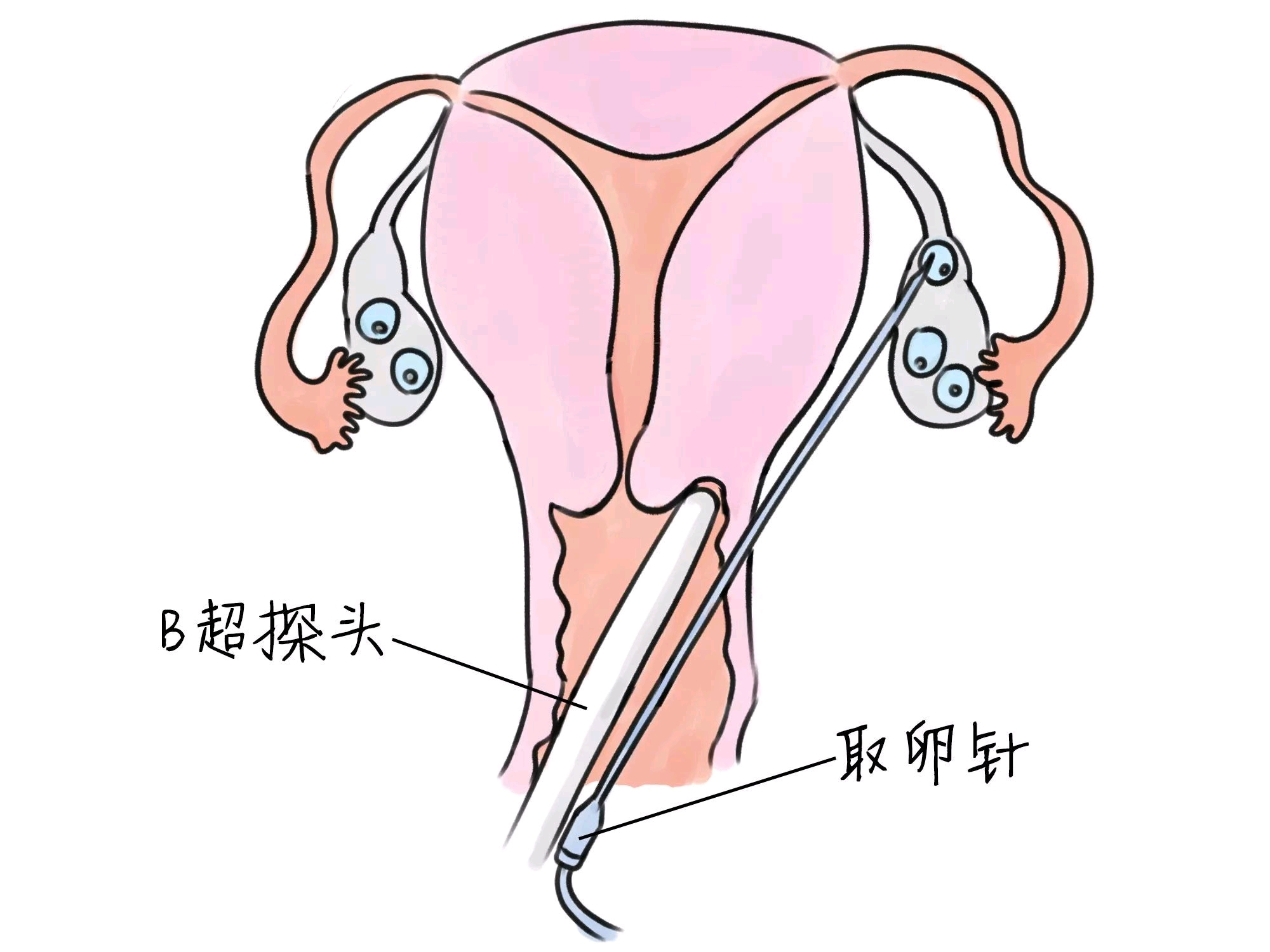 江门试管婴儿