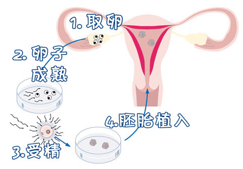 杭州邵逸夫医院试管婴儿