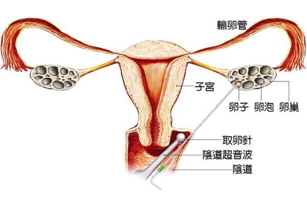 毓璜顶试管婴儿